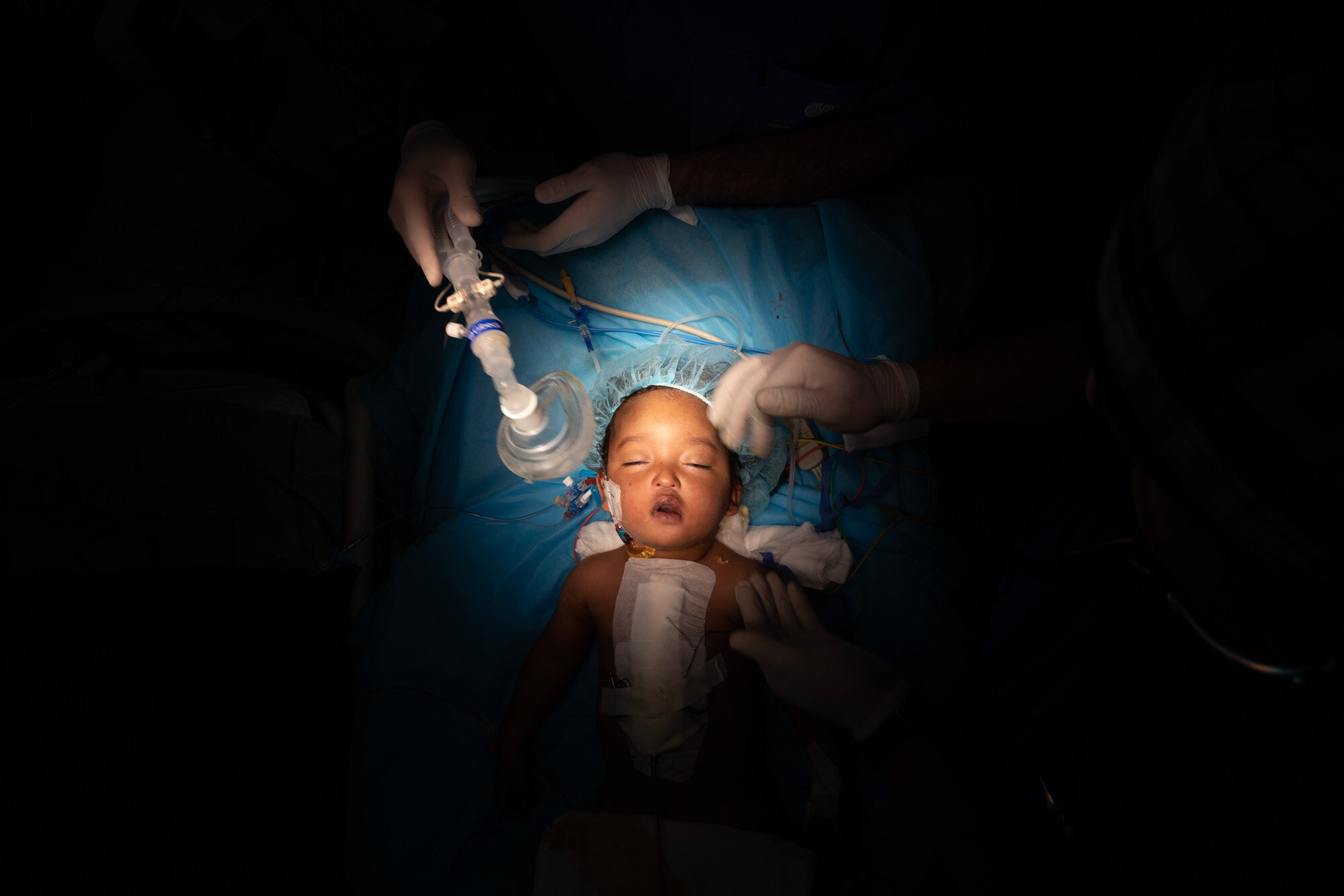  One-year-old Yazan has his oxygen mask removed after heart surgery at the Tajoura National Heart Center in Tripoli, Libya, on Feb. 27, 2020. Yazan’s perilous trek from his small desert hometown culminated in a five-hour surgery. He is one of 1,000 c