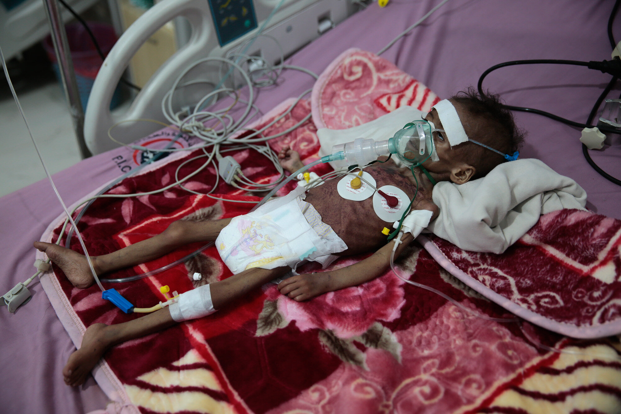 A malnourished girl, Rahmah Watheeq, receives treatment at a feeding center at Al-Sabeen hospital in Sanaa, Yemen, on Nov. 3, 2020. Two-thirds of Yemen's population of about 28 million people are hungry, and nearly 1.5 million families currently rely entirely on food aid to survive, with another million people expected to fall into crisis levels of hunger before the year’s end, according to aid agencies working in Yemen. (AP Photo/Hani Mohammed)