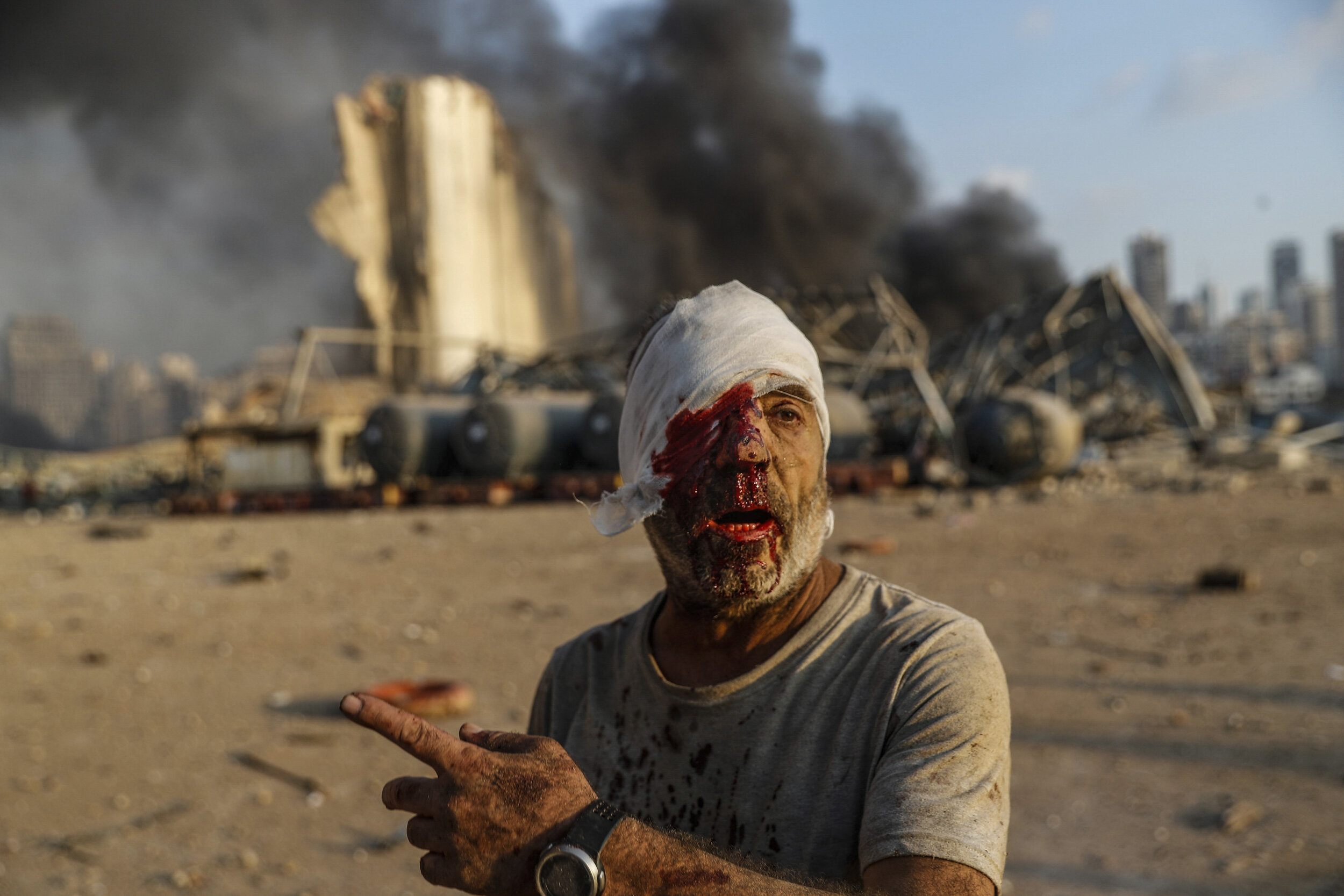  An injured man walks at the explosion scene that hit the seaport, in Beirut Lebanon, Aug. 4, 2020. AP Photo by Hussein Malla 