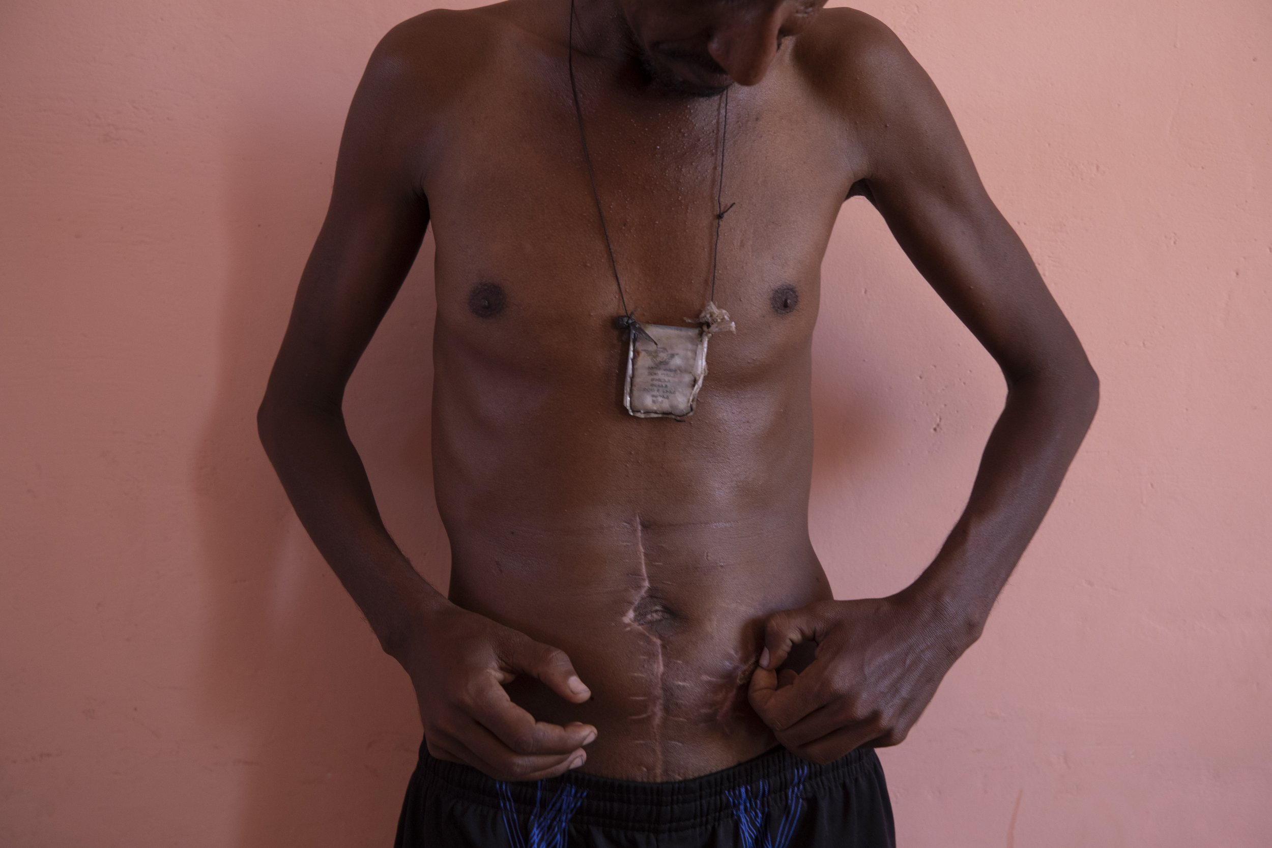  Nega Chekole, 30, a farmer and Tigrayan refugee from Humera, touches his stitched wound in Hamdayet, eastern Sudan, near the border with Ethiopia, on March 14, 2021. Chekole says he was shot by militias before the war broke out in November 2020. Tig