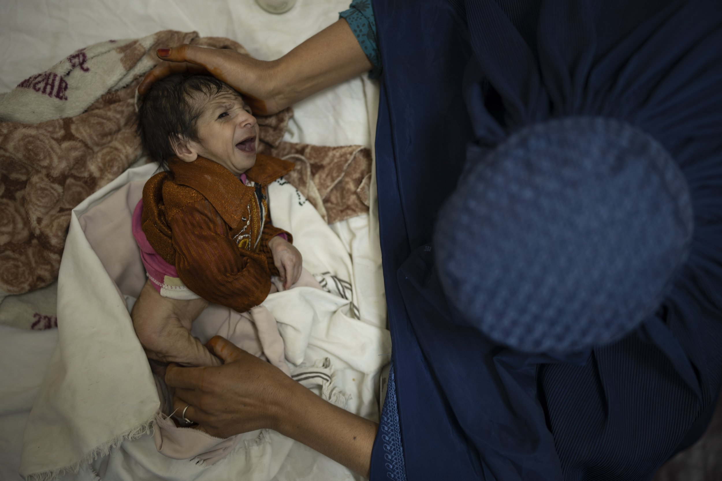  Sofia cradles her 2-month-old baby, Abdul, as he undergoes treatment at the malnutrition ward of the Indira Gandhi Children's Hospital in Kabul, Afghanistan, on Oct. 5, 2021. (AP Photo/Felipe Dana) 