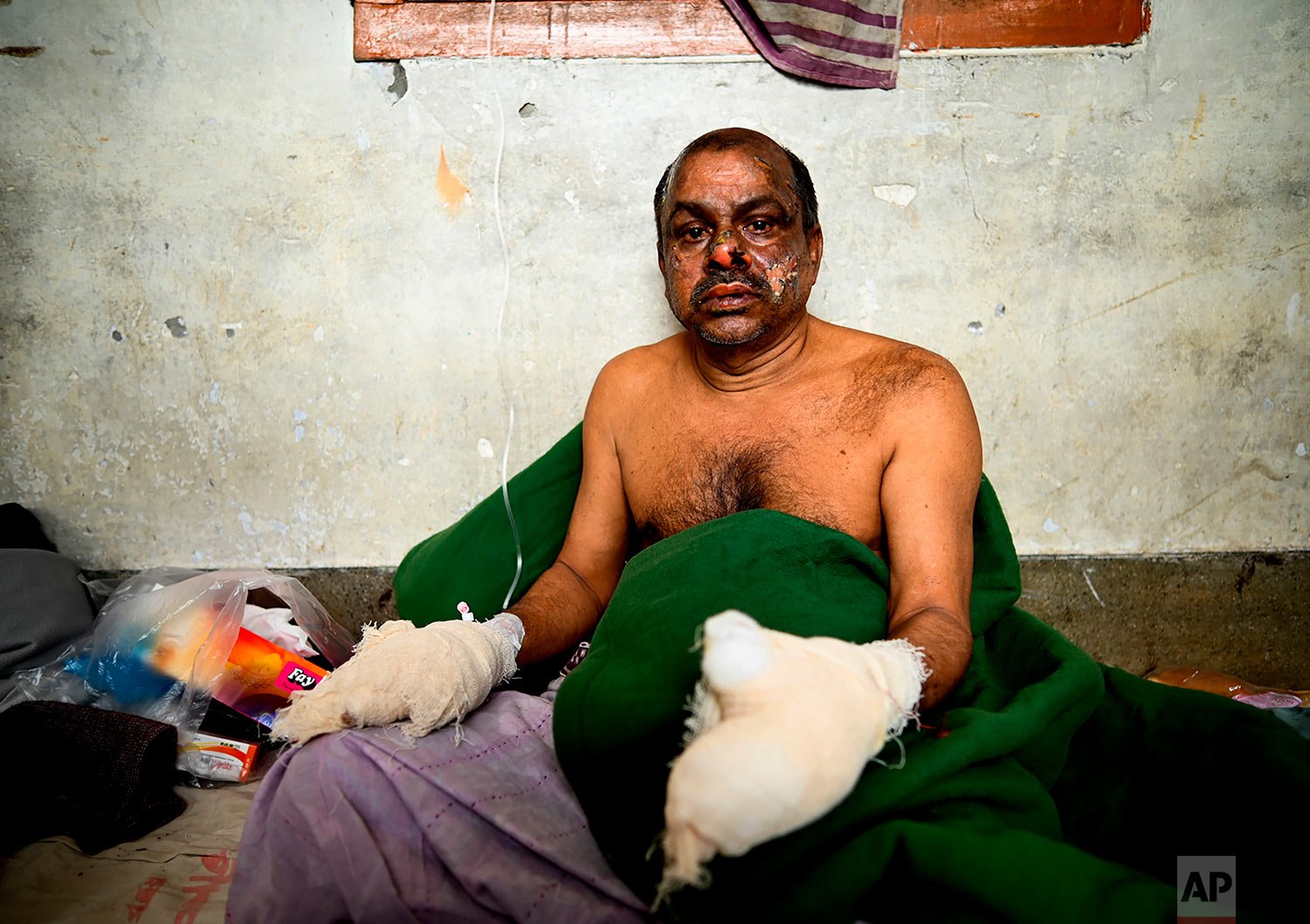  A survivor of a ferry fire receives treatment at a government medical hospital, in Barishal, Bangladesh, Friday, Dec. 24, 2021. (AP Photo/Niamul Rifat) 