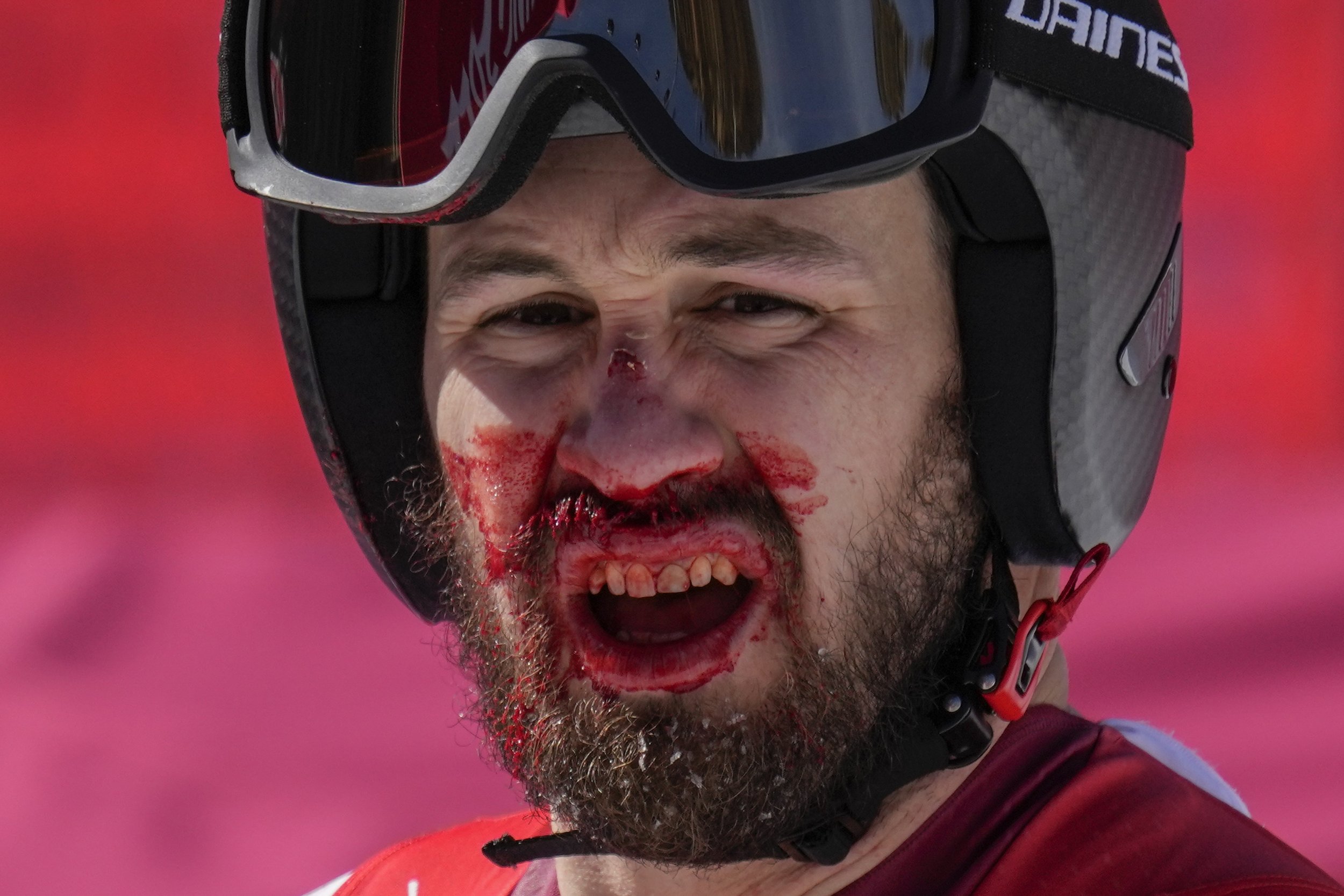  Daniel Hemetsberger, of Austria, bleeds after finishing the men's downhill at the 2022 Winter Olympics, Monday, Feb. 7, 2022, in the Yanqing district of Beijing.(AP Photo/Luca Bruno) 