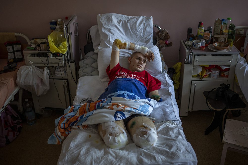  Anton Gladun lies on his bed at the Third City Hospital in Cherkasy, Ukraine, Thursday, May 5, 2022. Anton, a 22-year-old military medic deployed on the front lines in eastern Ukraine, lost both legs and left arm in a mine explosion on March 27. (AP