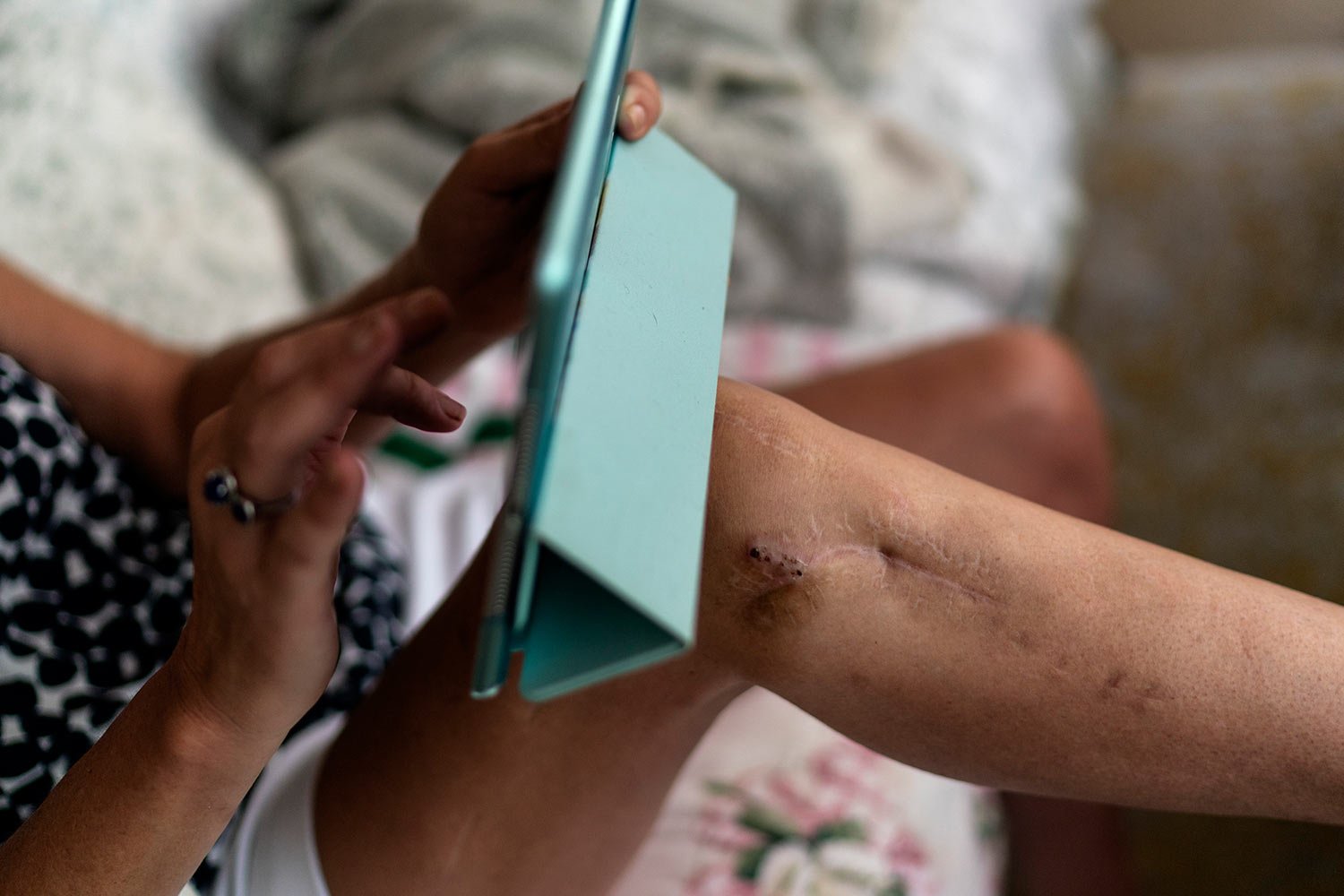  Scars remain from a shooting by the estranged husband of Janet Paulsen as she rests at her home in Acworth, Ga., Monday, Aug. 7, 2023. (AP Photo/David Goldman)  