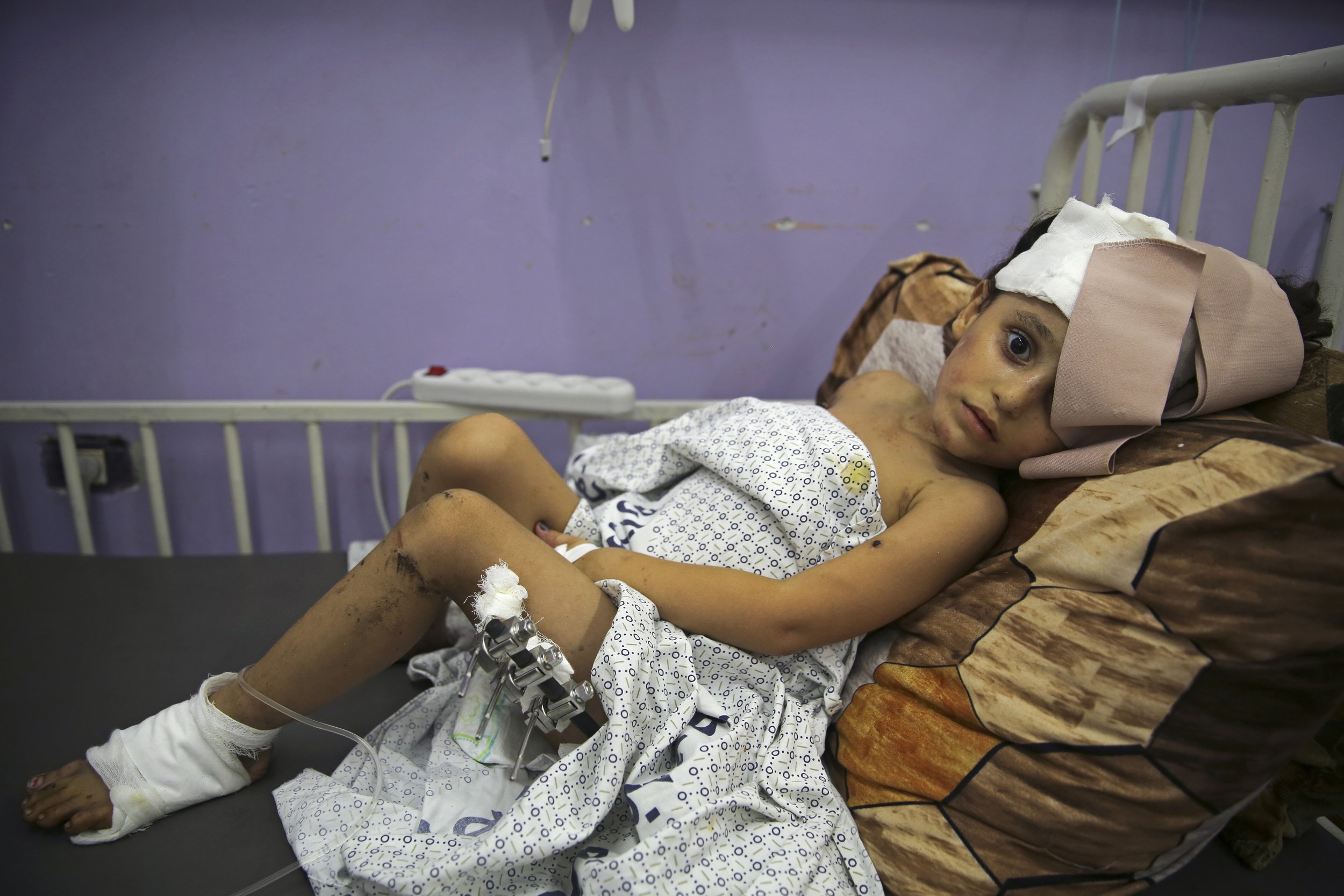  Kenzi al Madhoun, a four-year-old who was wounded in an Israeli bombardment, lies on a bed at Al Aqsa Hospital in Deir al Balah, Gaza Strip, on Nov. 1, 2023. (AP Photo/Abdel Kareem Hana) 