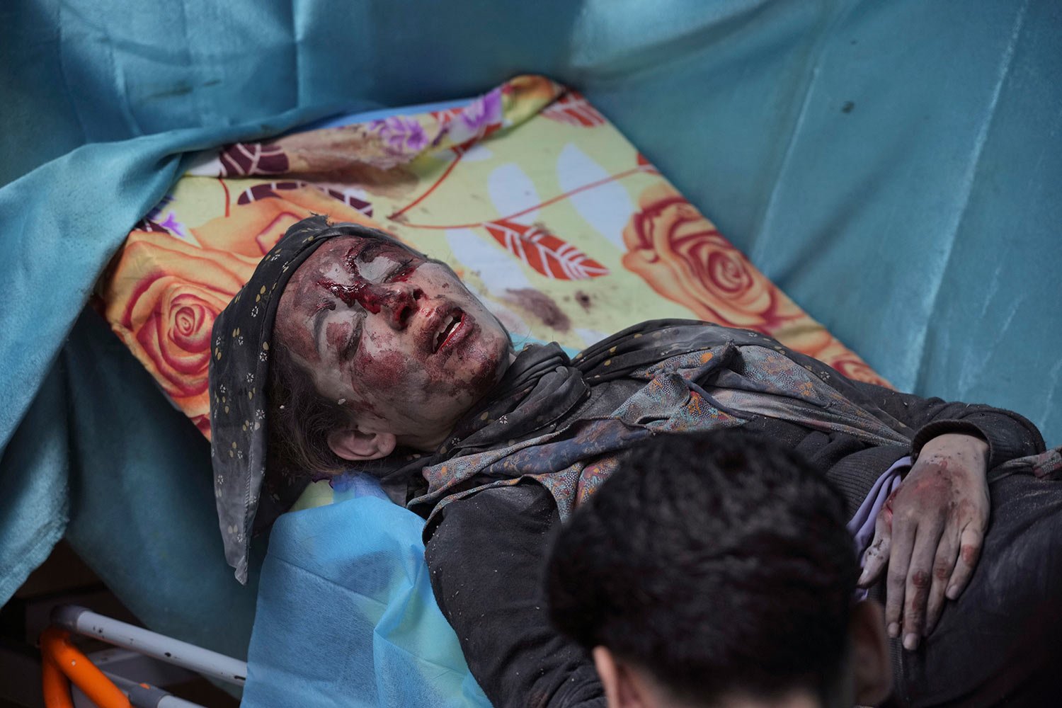  A Palestinian wounded in Israeli bombardment waits for treatment in a hospital in Deir al-Balah, southern Gaza Strip, Friday, Oct. 20, 2023. (AP Photo/Hatem Moussa) 