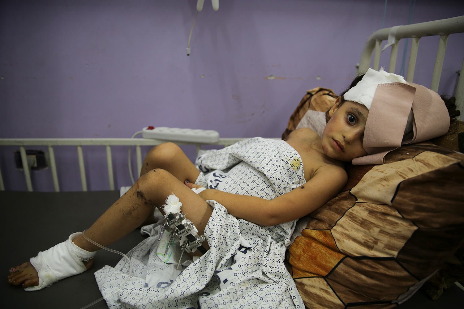  Kenzi al Madhoun, a four-year-old who was wounded in Israeli bombardment lies at Al Aqsa Hospital in Deir al Balah City, Gaza Strip, Wednesday, Nov. 1, 2023. (AP Photo/Abdel Kareem Hana) 