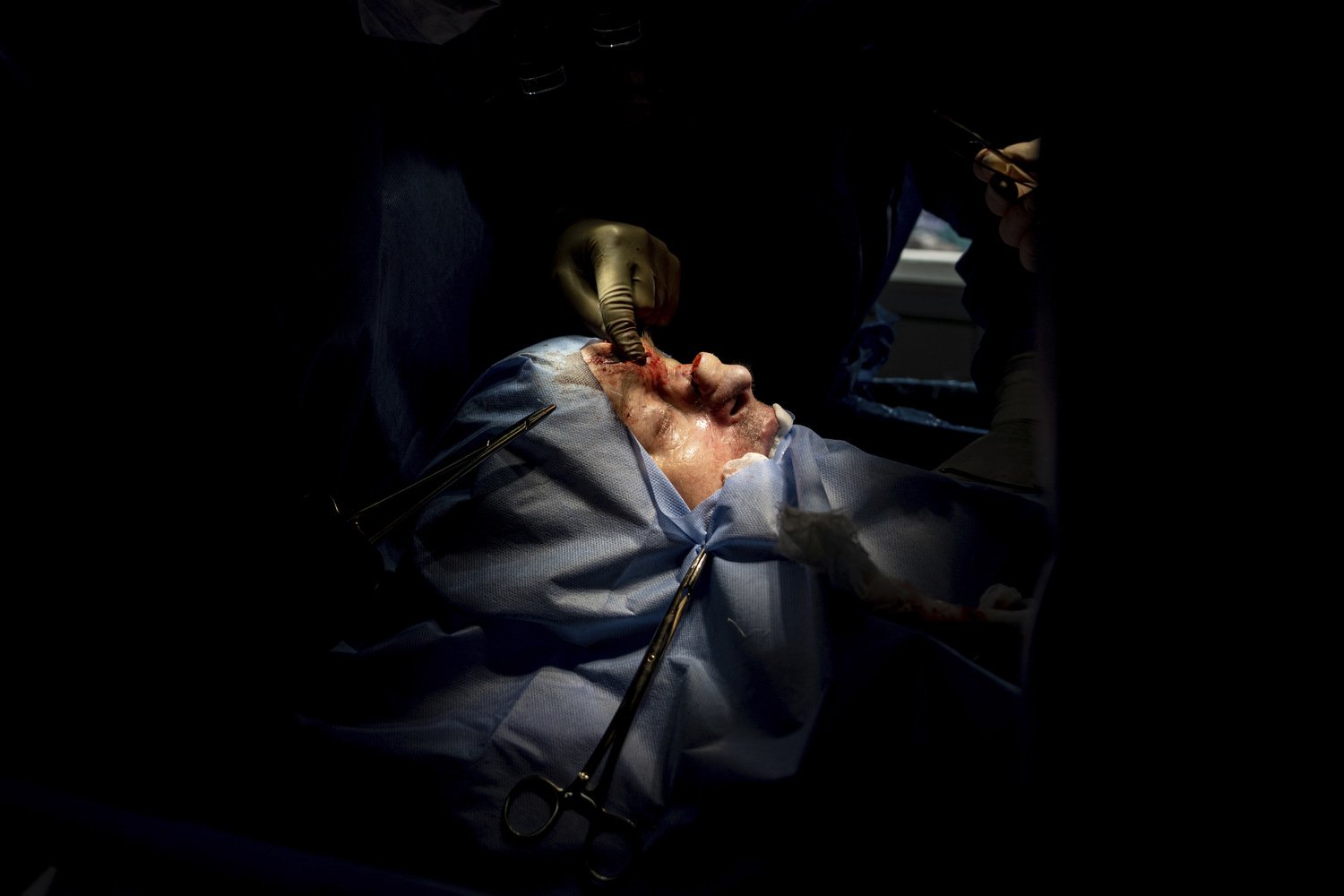  Dr. Natalia Komashko, performs reconstructive surgery on the nose of Leonid Prokopovych, a 50-year-old Ukrainian serviceman, in Ivano-Frankivsk, Ukraine, Friday, July 21, 2023. It was his third nasal surgery, and he had a series of operations to rep