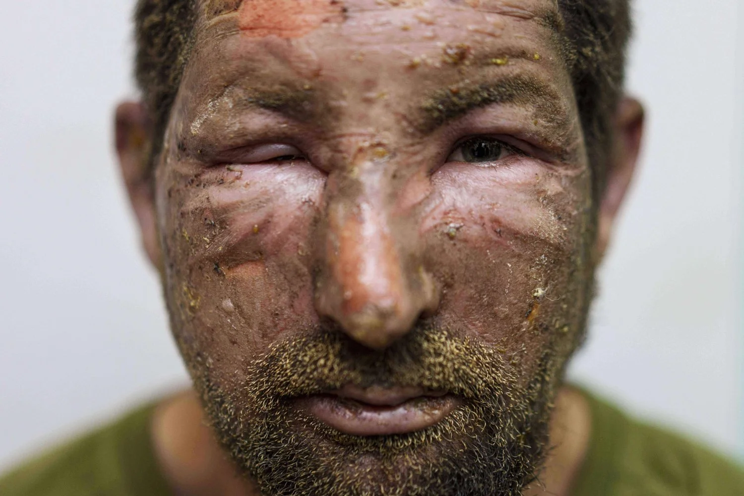 Burns cover the face of Artem aka "Lisnyk," a Ukrainian soldier from the Da Vinci Wolves Battalion who was injured during fighting with Russian forces on the Pokrovsk front, Aug. 10, 2025. (AP Photo/Evgeniy Maloletka)