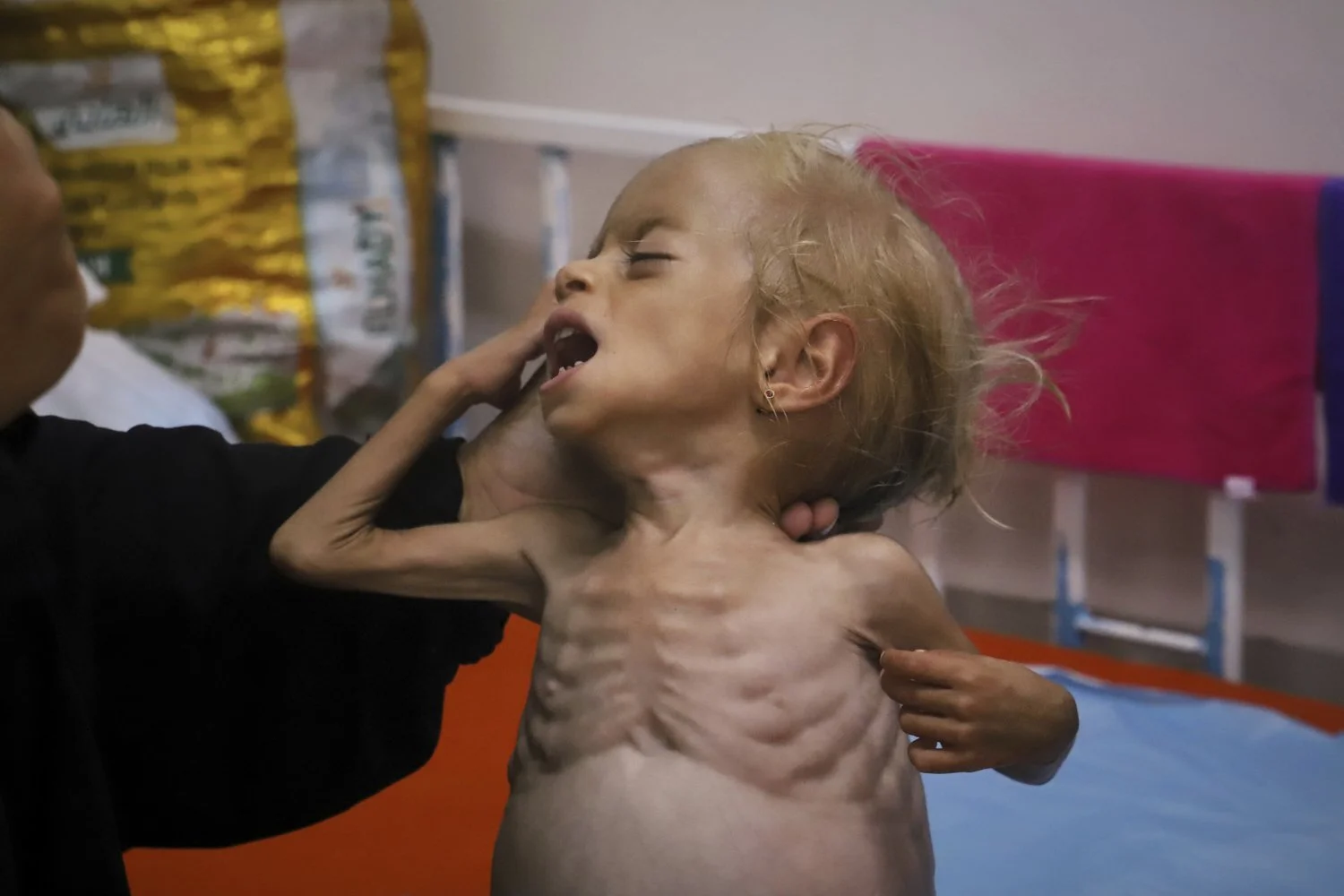 Islam Qudeih shows her severely malnourished shirtless, 2-year-old daughter, Shamm, to journalists at Nasser Hospital in Khan Younis, southern Gaza Strip, Aug. 9, 2025. Doctors said Shamm may have a genetic disorder that affects muscle and bone deve
