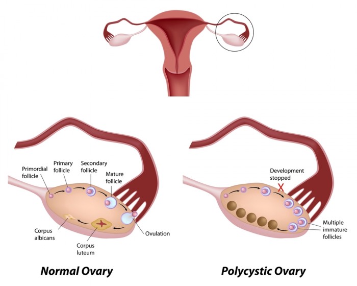 Ved PCO/PCOS så får man ikke eggløsning, og eggposen blir bare liggende å blir til små cyster. Men det er hjelp å få :-)
