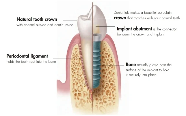 Image from http://www.straumann.ca