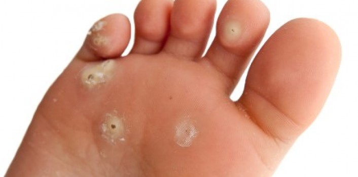 wart on foot causing pain)