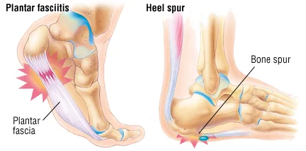 heelpain.jpg