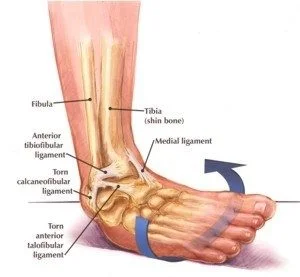 chronic-ankle-instability-300x277.jpg