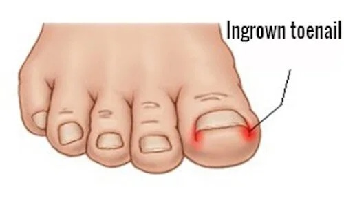 ingrowntoenail.jpg