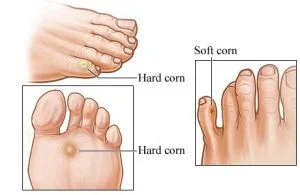 CORNS.jpg