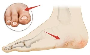 Dry-Cracked-Feet-300x185.jpg