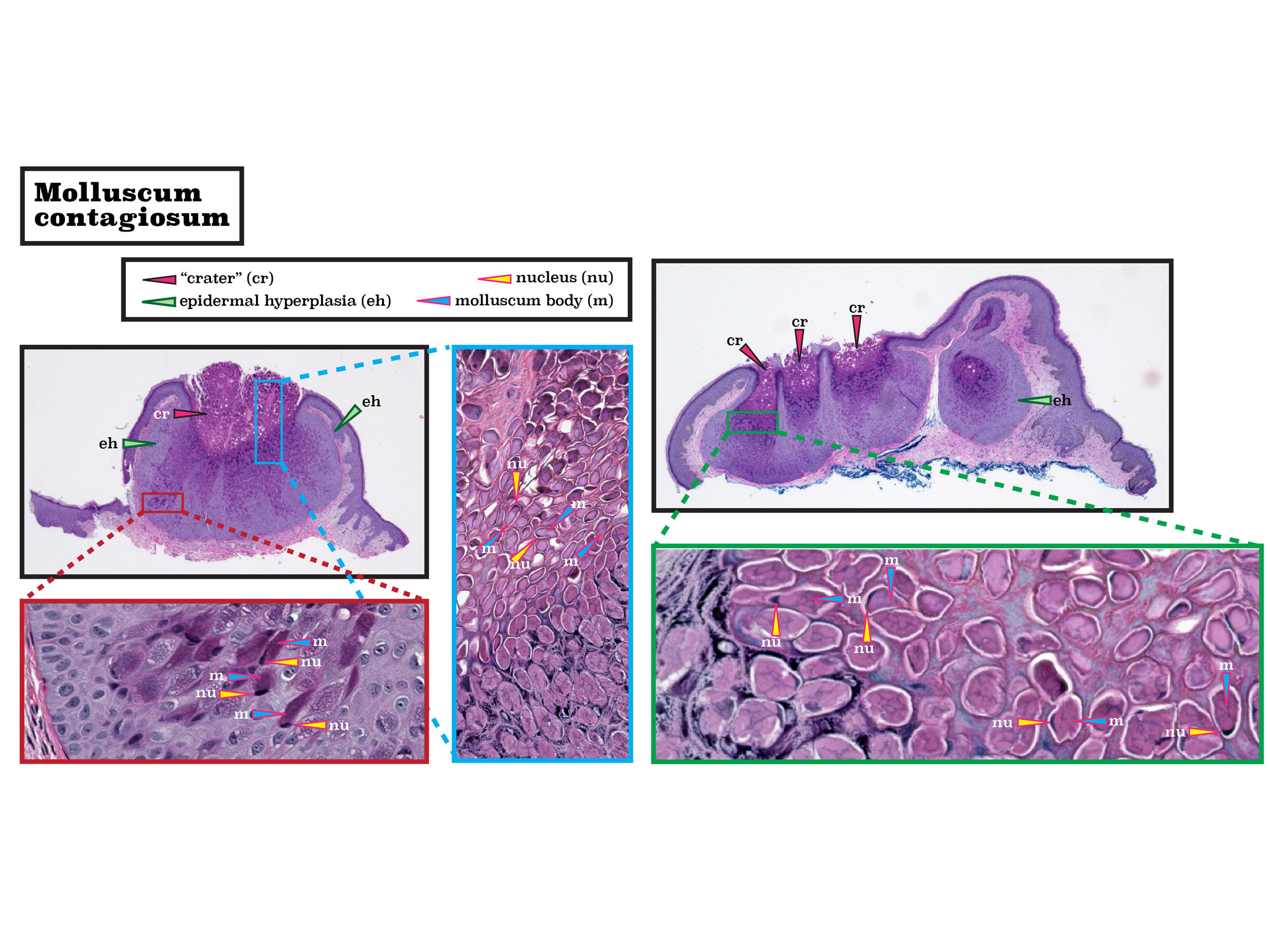 Z 16 MOLLUSCUM-01.jpg