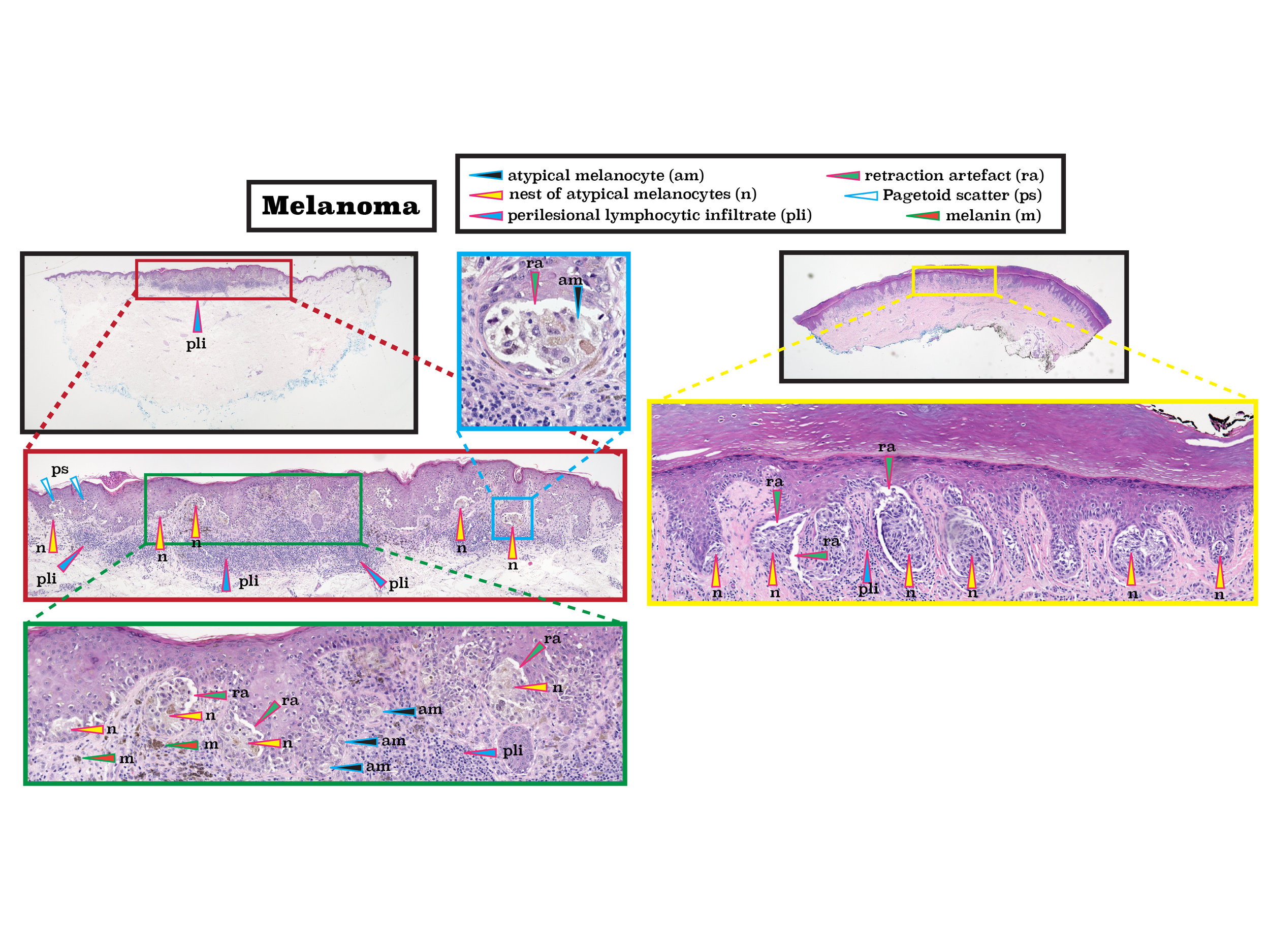 Z 15 melanoma-01.jpg