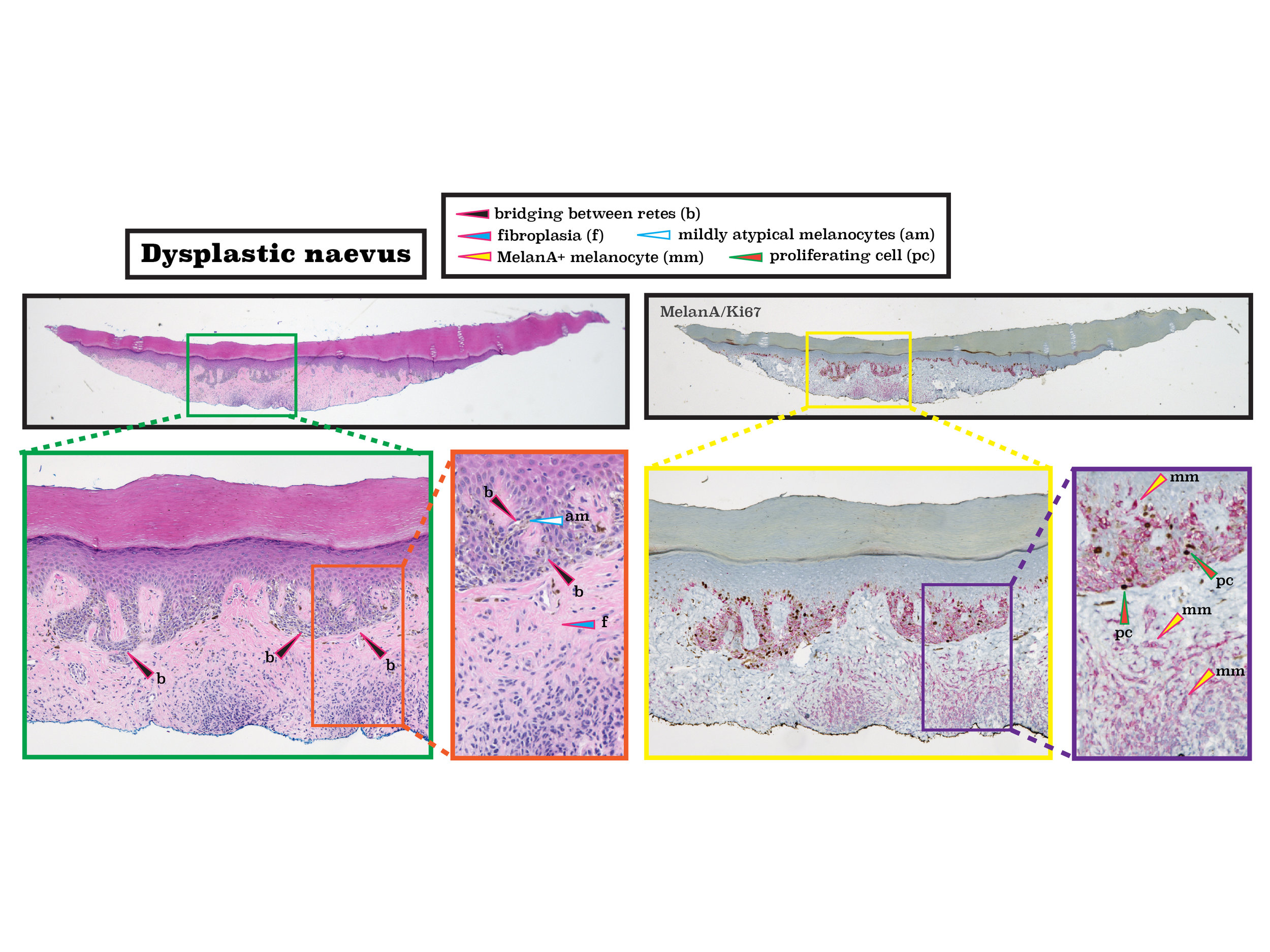 Z 14 dysplastic nevus-01.jpg