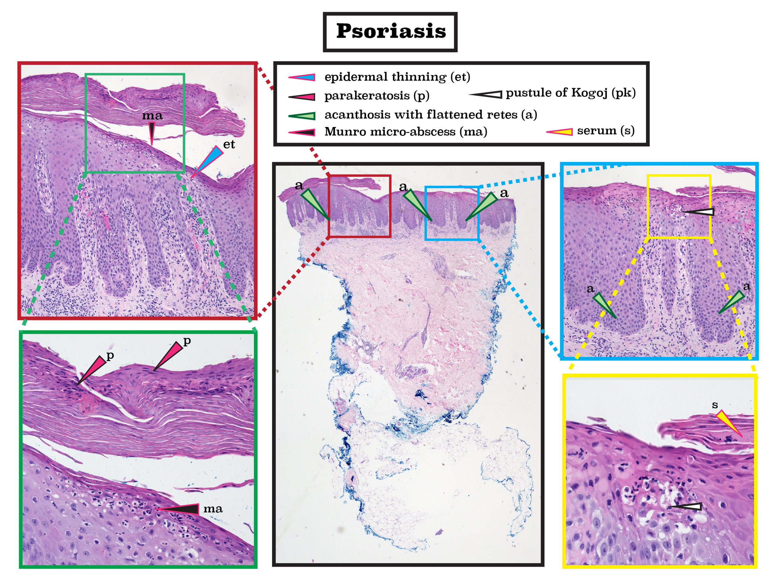 Z 4 psoriasis-1-01.jpg