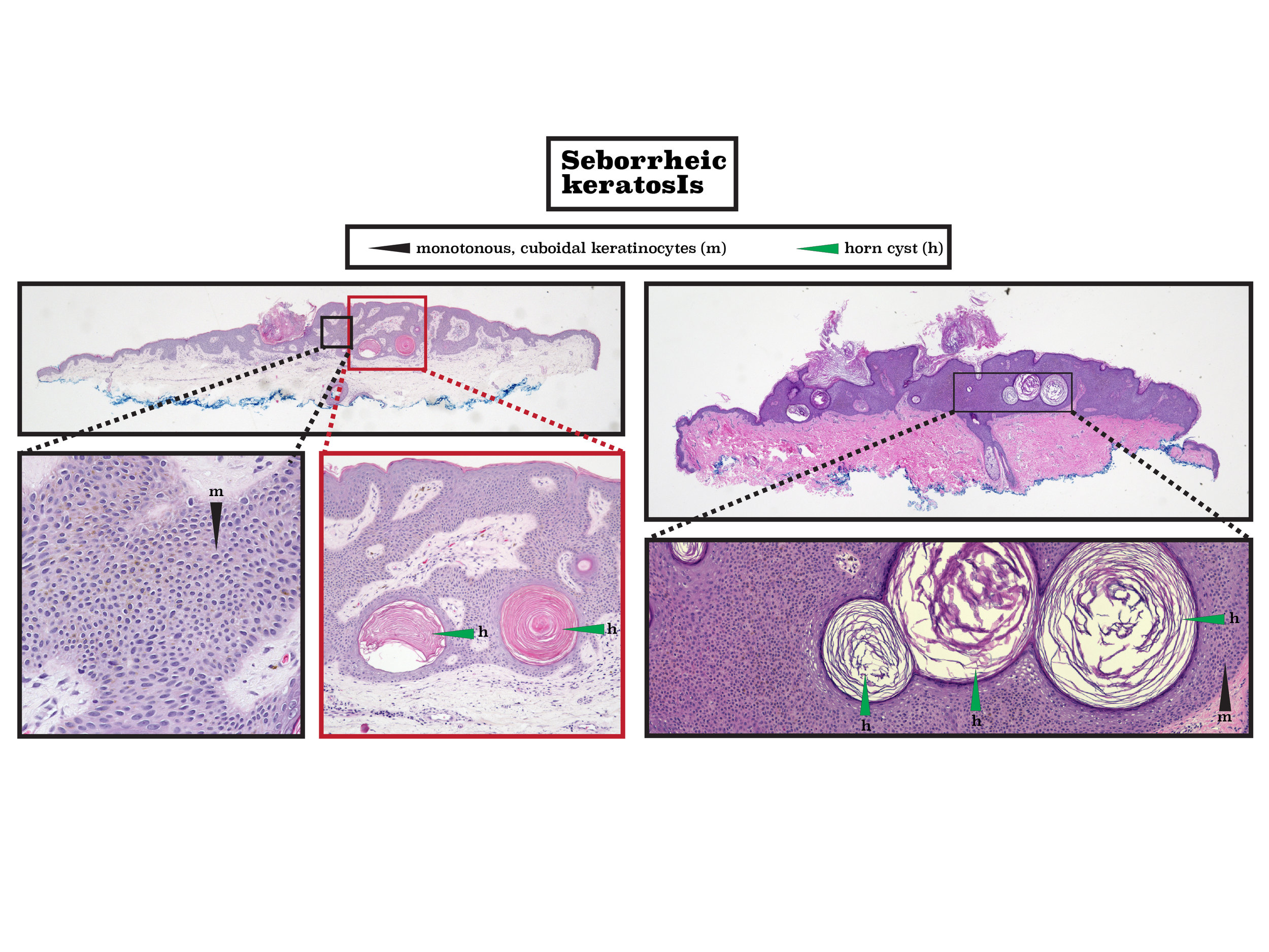 Z 3 sebborheic keratosis-01.jpg