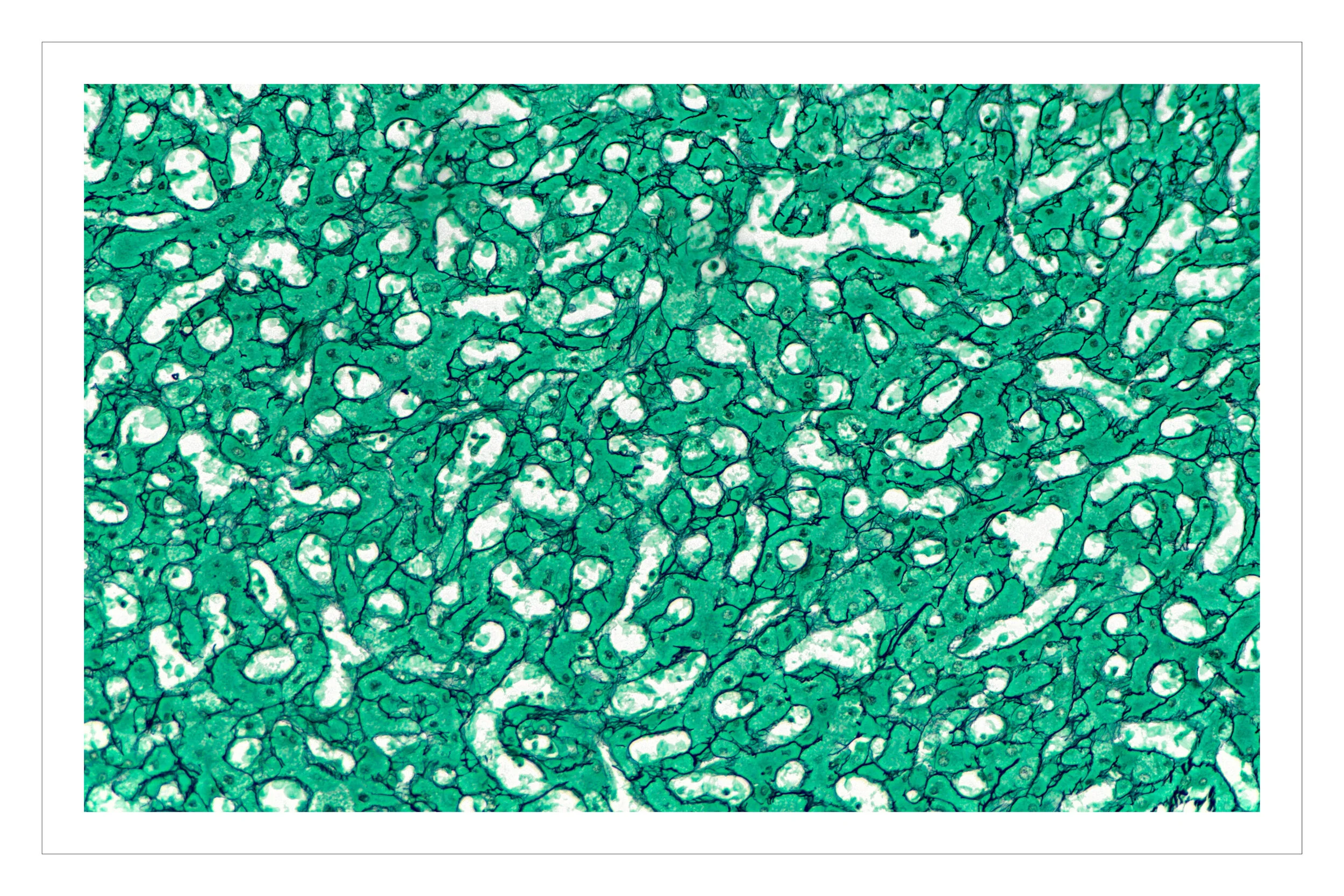 cirrhosis-01.jpg