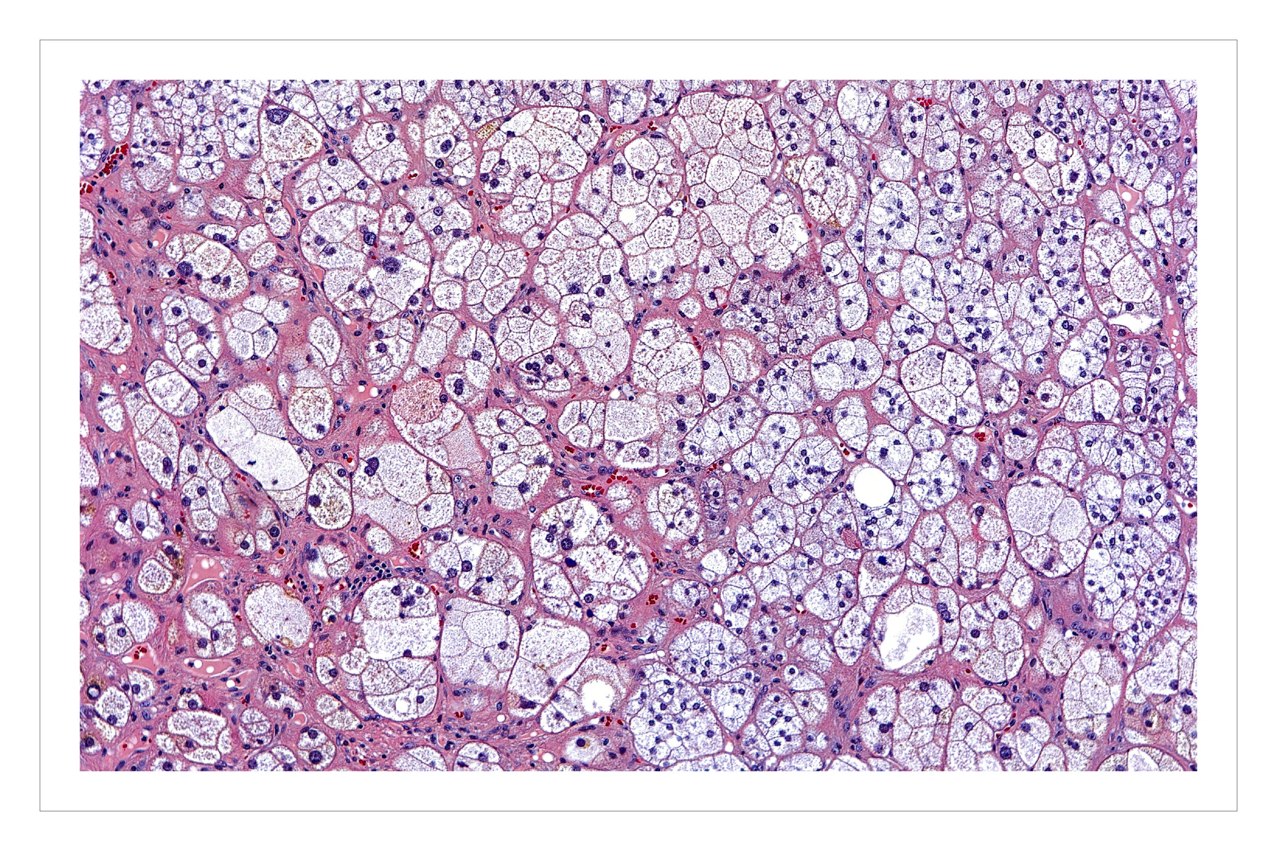 adrenal adenoma-01.jpg