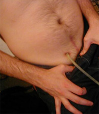 HTTP://DXLINE.INFO/DISEASES/SUPRAPUBIC-CATHETER-CARE