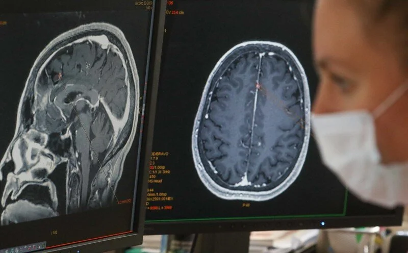 COVID-19 AND THE BRAIN 
