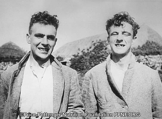 Brothers, one was raised on a traditional gaelic diet in scotland while the other ate "modern" foods for a long stint in a nearby town. Guess which one.
