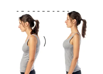 Left: woman has kyphosis, Right: woman hides kyphosis by thrusting her ribs forward.