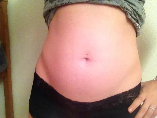 Inflamation / Swelling - Novemeber 2013, pre-first surgery