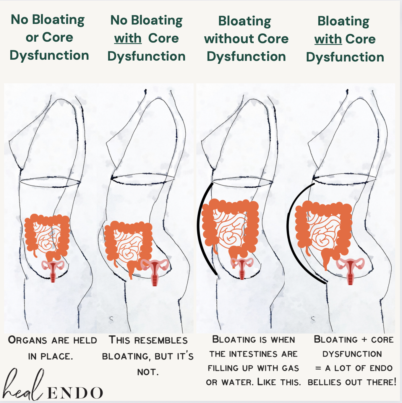 What is Endo Belly: Endometriosis Bloat, Digestive Disfunction — Heal Endo