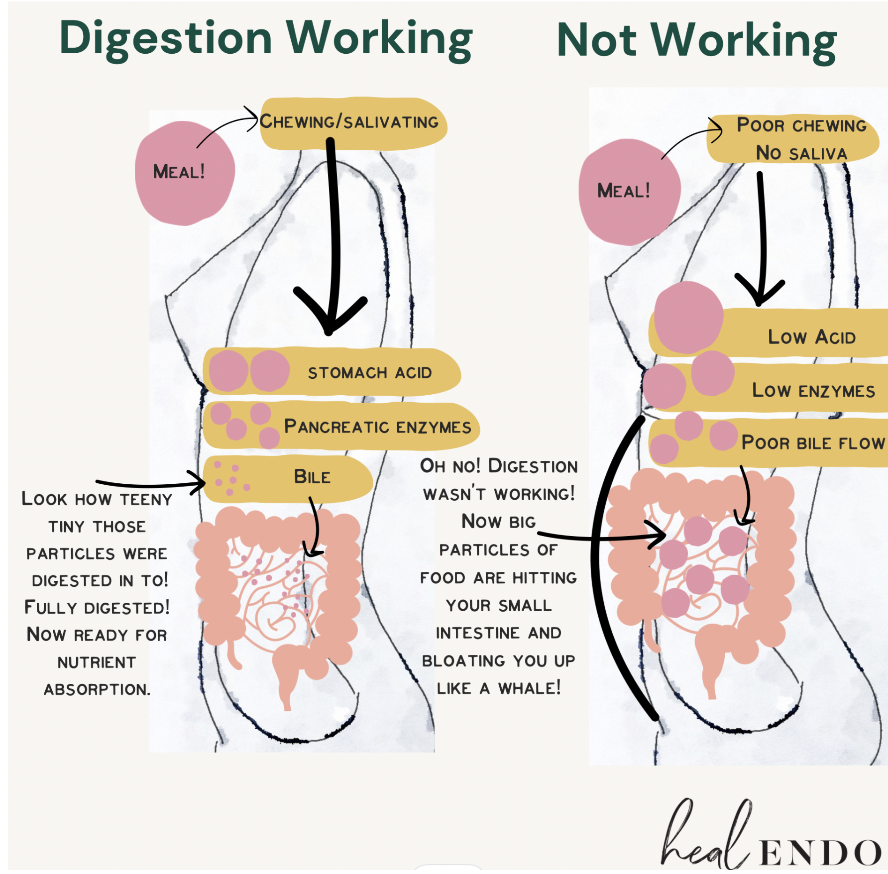 Comparison chart showing how healthy digestion breaks food into tiny particles versus poor digestion, which causes large food particles to hit the small intestine and trigger endo belly bloating.