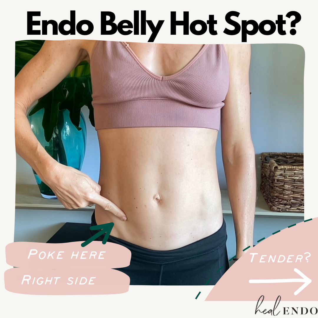 What is Endo Belly Series: Ileocecal valve pain — Heal Endo