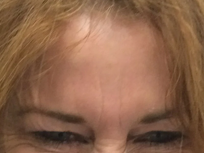 Frown after Wrinkle Relaxer treatment