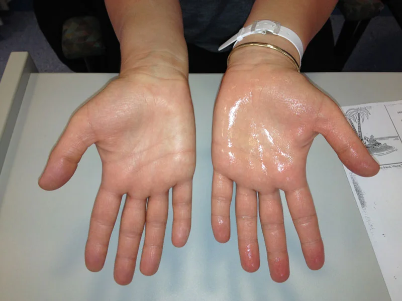 Thorascopic Sympathectomy Treatment performed on right side (left hand)