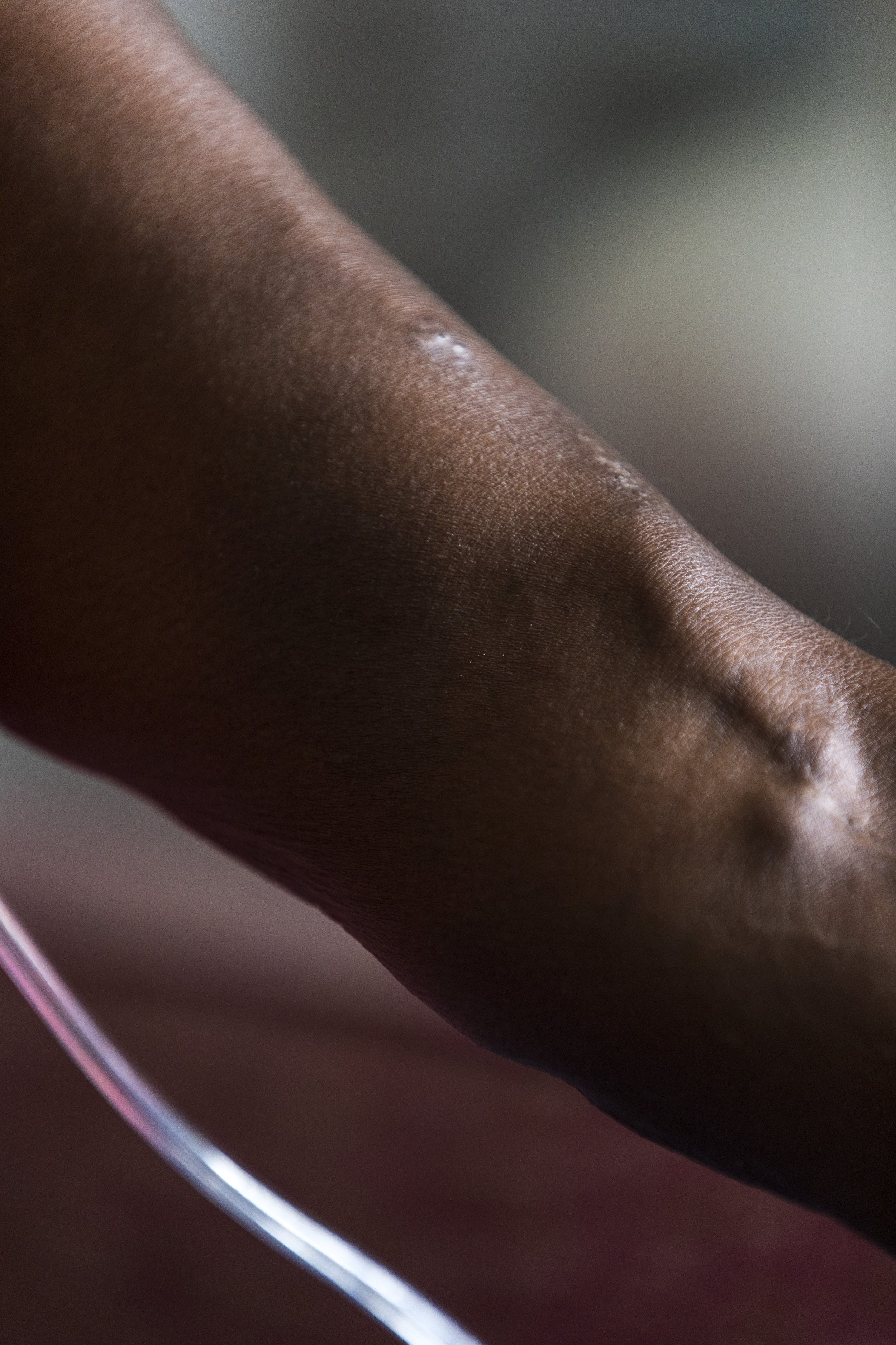  Crystal Dickens shows off her dialysis fistula in her hotel room in Jacksonville, NC on Tuesday, July 18, 2023. (Rachel Jessen for NBC News) 