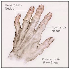Osteoarthritis