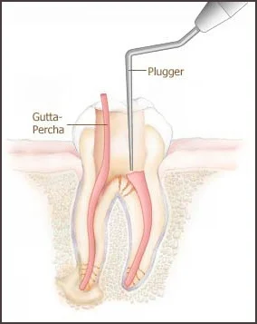 Root Canal, detail