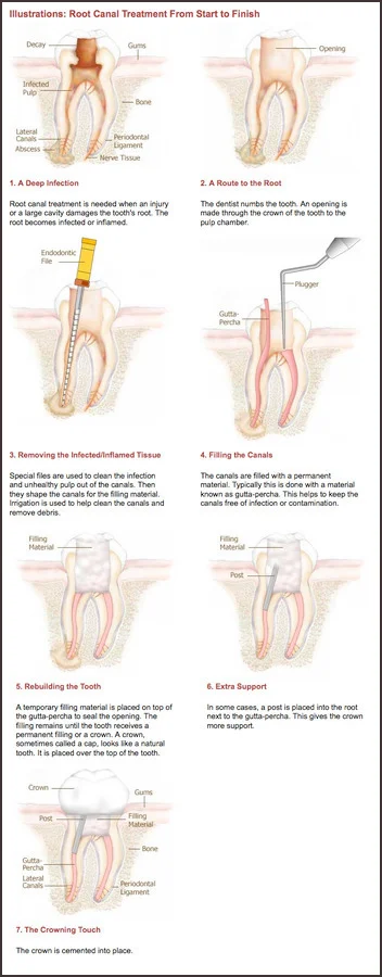Root Canal