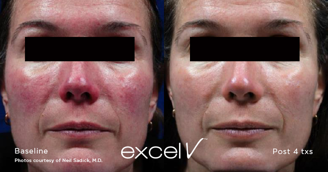 Rosacea