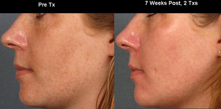 Pigmentation