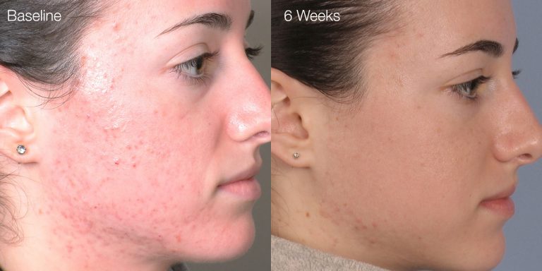 Acne results after 4 treatments.