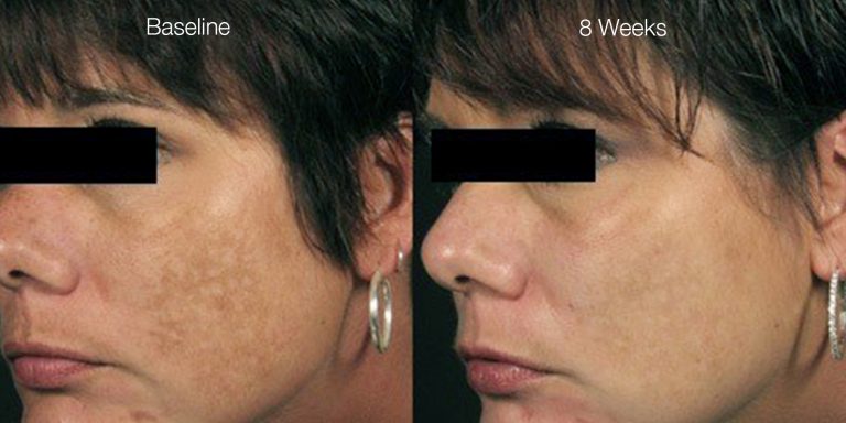 Melasma pigmentation results after 5 treatments.