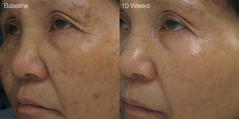 Solar lentigo sun damage results after 6 treatments.