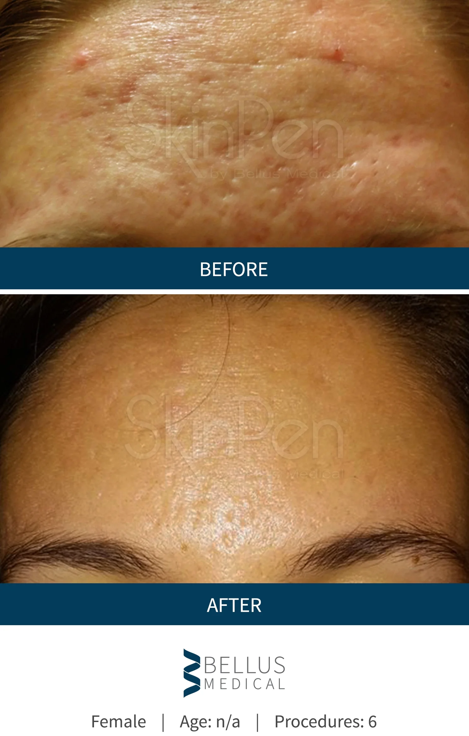 b-a-pores.jpg